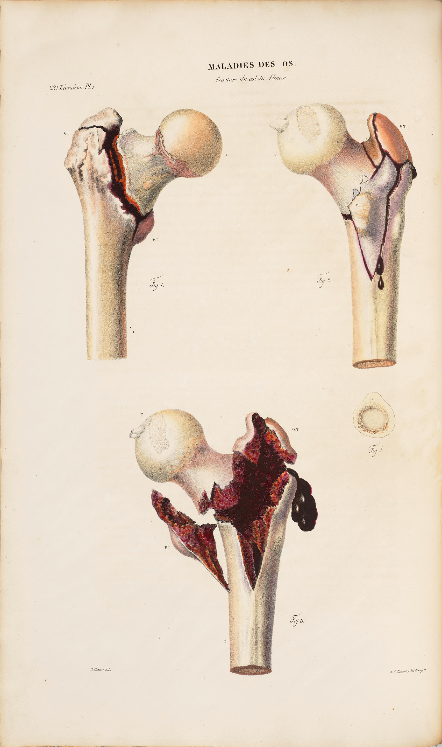 Appraisal: CRUVEILHIER JEAN - Anatomie pathologique du corps humain Paris J