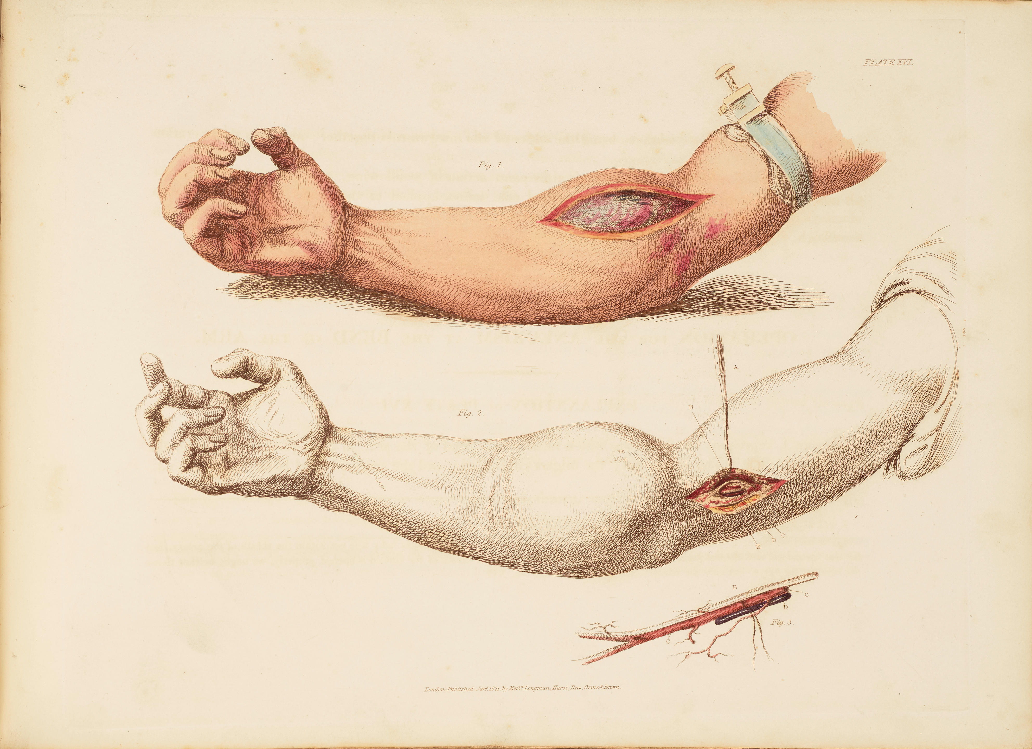 Appraisal: BELL CHARLES - Illustrations of the Great Operations of Surgery