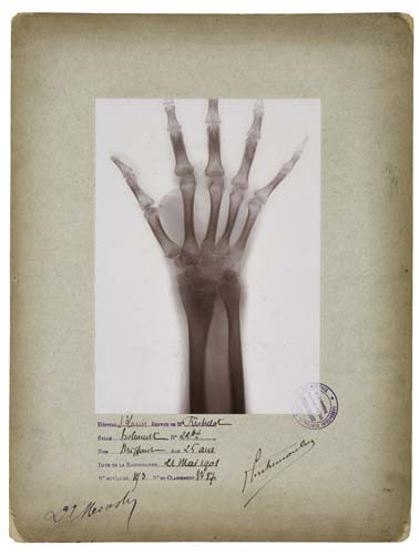 Appraisal: MEDICAL X-Ray of the hand of a -year old man