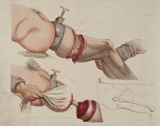 Appraisal: Bell Sir Charles Illustrations of the Great Operations of Surgery