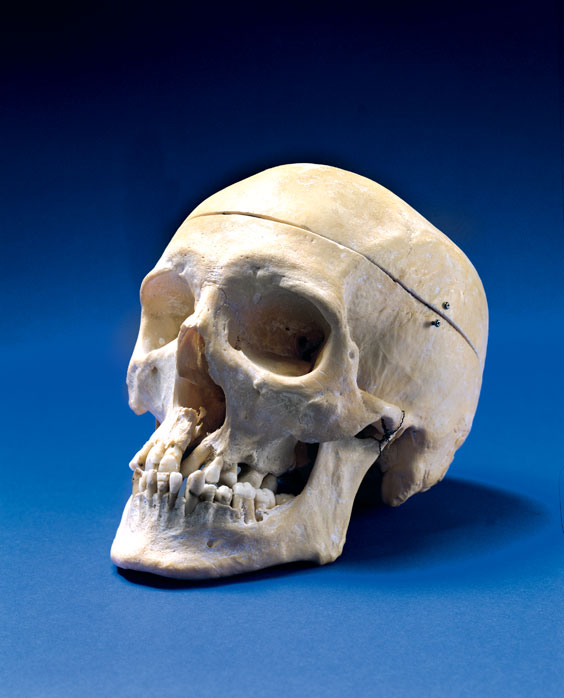 Appraisal: MEDICAL HUMAN SKULL PREPARATION This special example of an adult