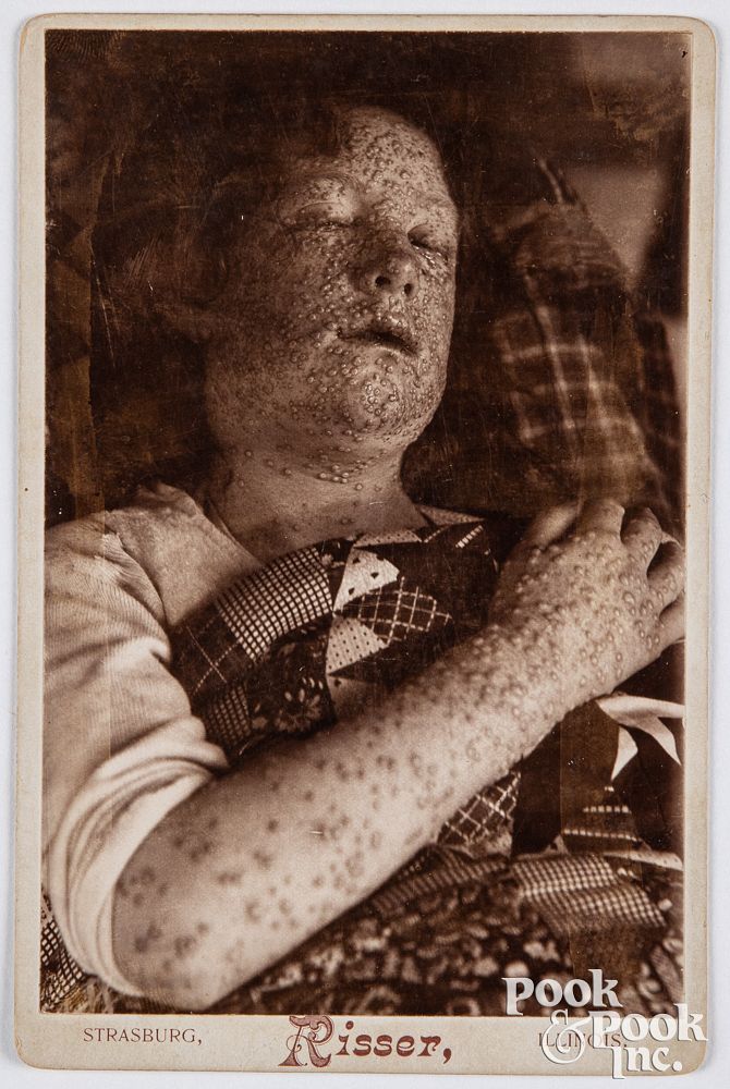 Appraisal: Cabinet card photograph of a smallpox patient Cabinet card photograph